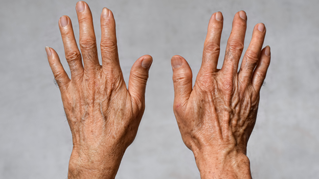 A person holding up their hands with liver spots on them